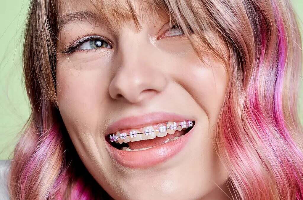 Invisalign Vs. Lightforce Braces: Which Is Right For You?